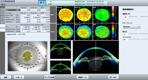白内障術後の角膜形状、隅角、IOLの観察