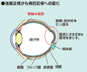 病的近視に伴う脈絡膜新生血管